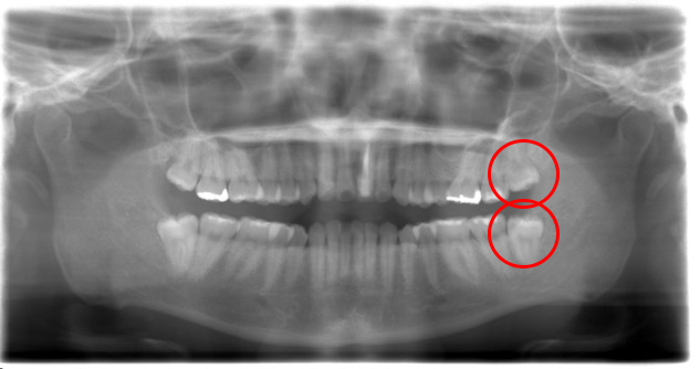 症例2 上下まとめて抜歯 ２本 医療法人社団まる歯の親知らず抜歯外来