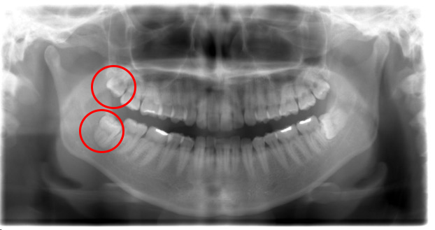 症例3 上下まとめて抜歯 ２本 親知らずの抜歯なら まる歯親知らず抜歯相談